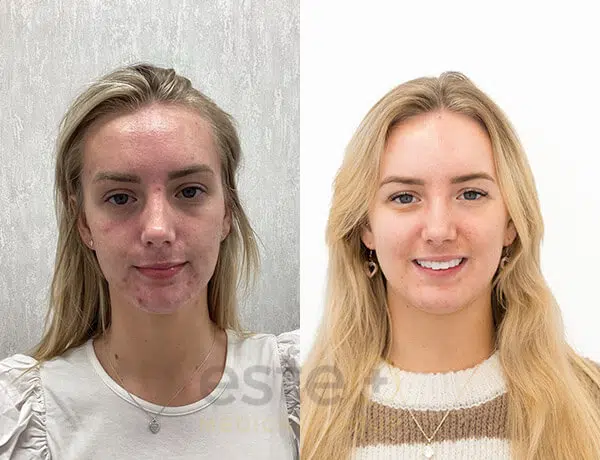 acne treatment transformation dubai