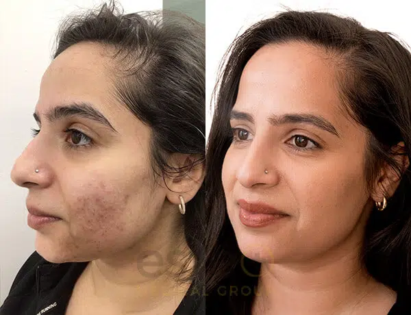 acne before after results dubai