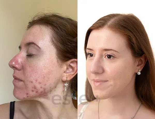acne treatment transformation dubai