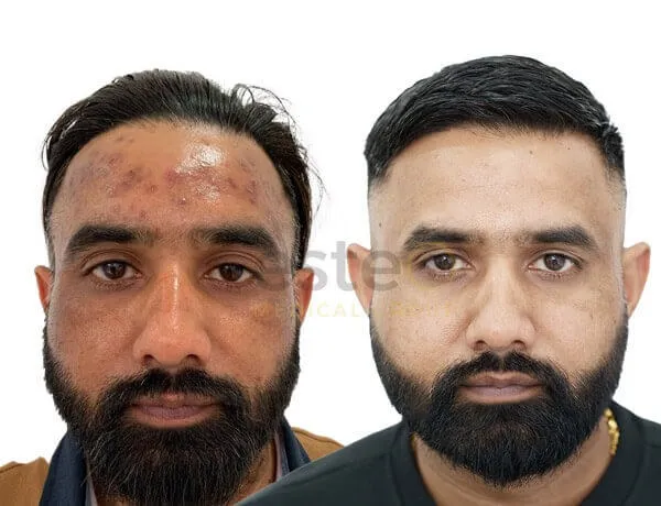 acne skin improvement results dubai