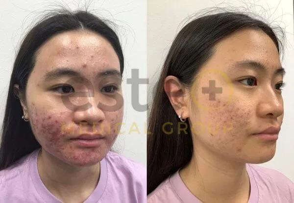 adult acne treatment result