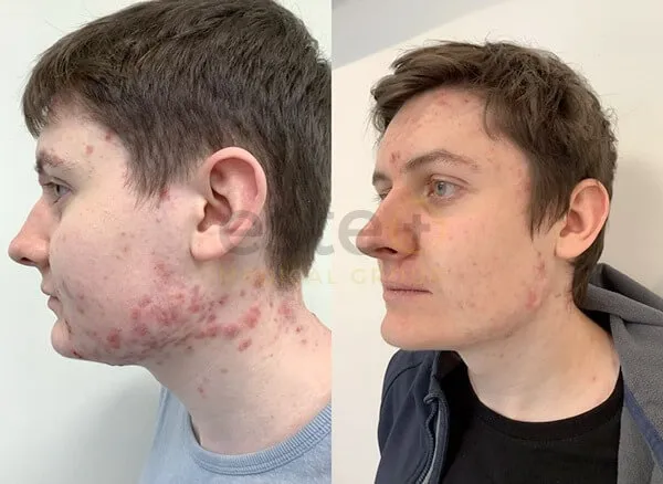 adult acne treatment before after dubai