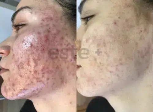 acne skin clarity results dubai clinic