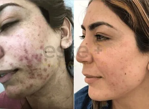 acne before after results dubai