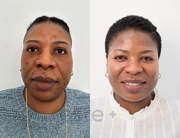 adult acne treatment before after dubai
