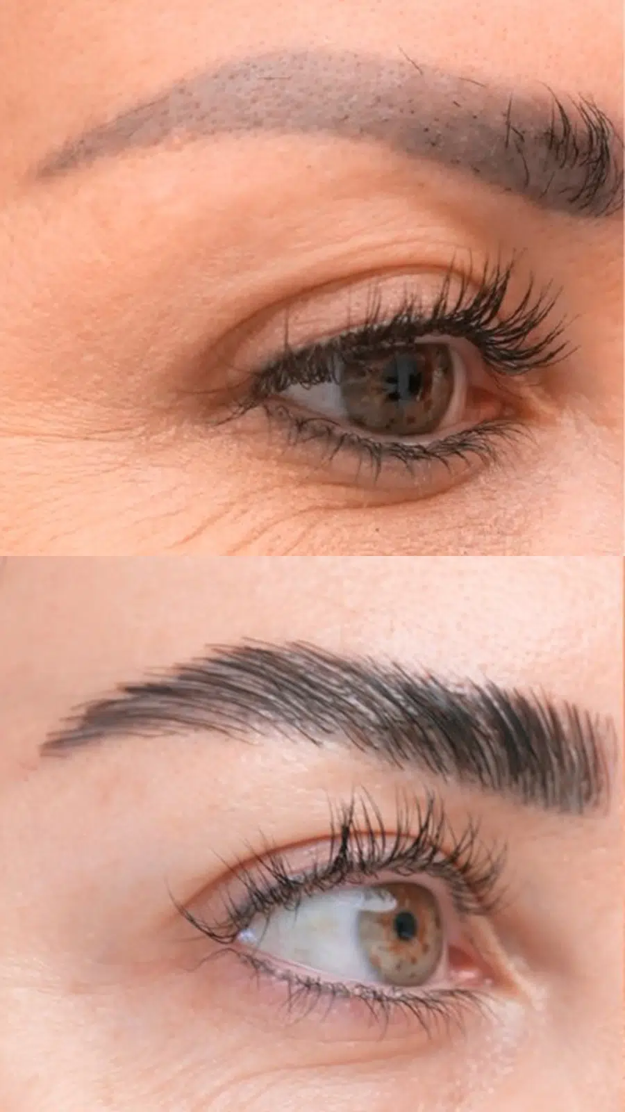 Eyebrow hair transplant before and after results