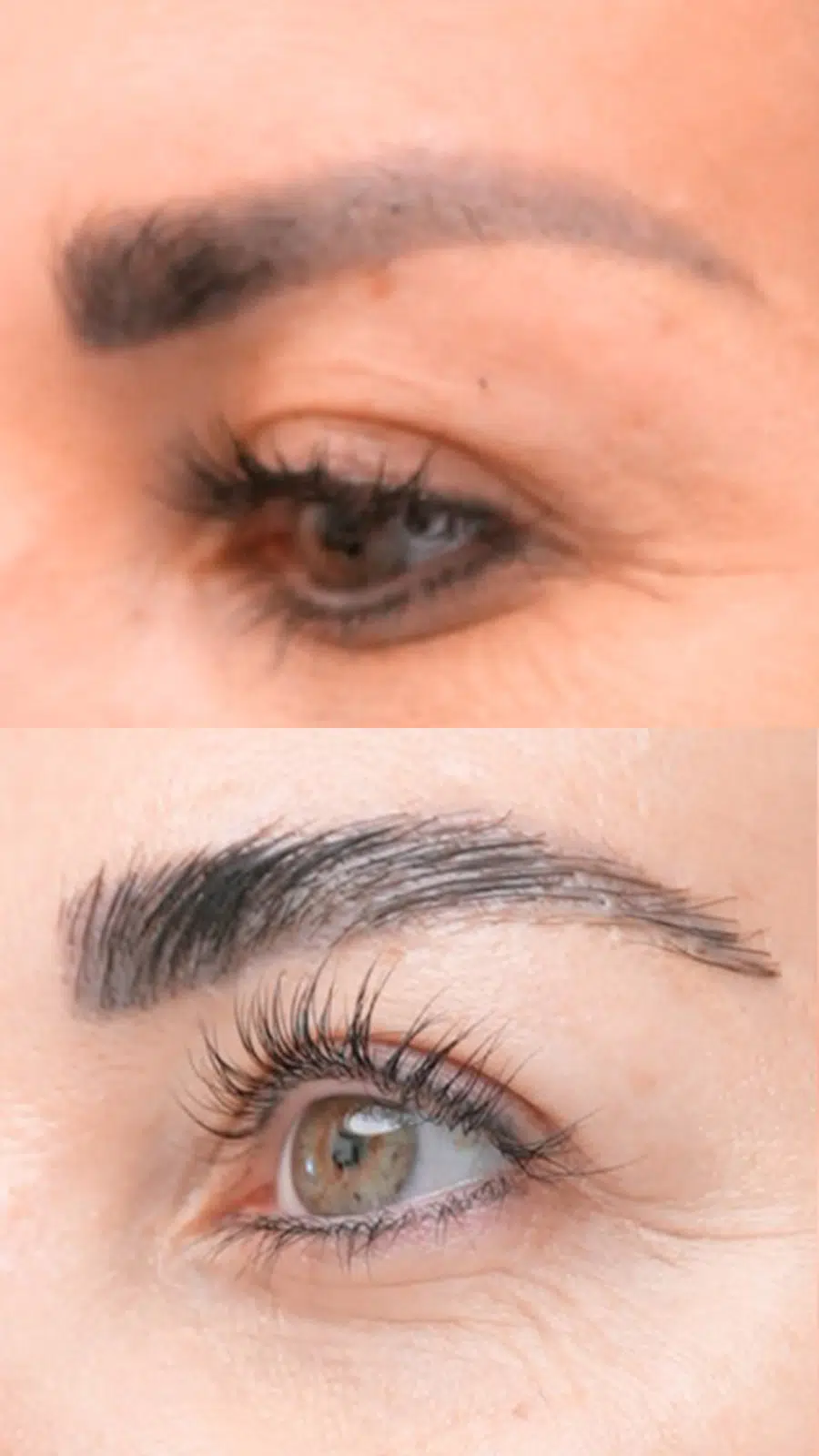 Eyebrow hair transplant treatment results