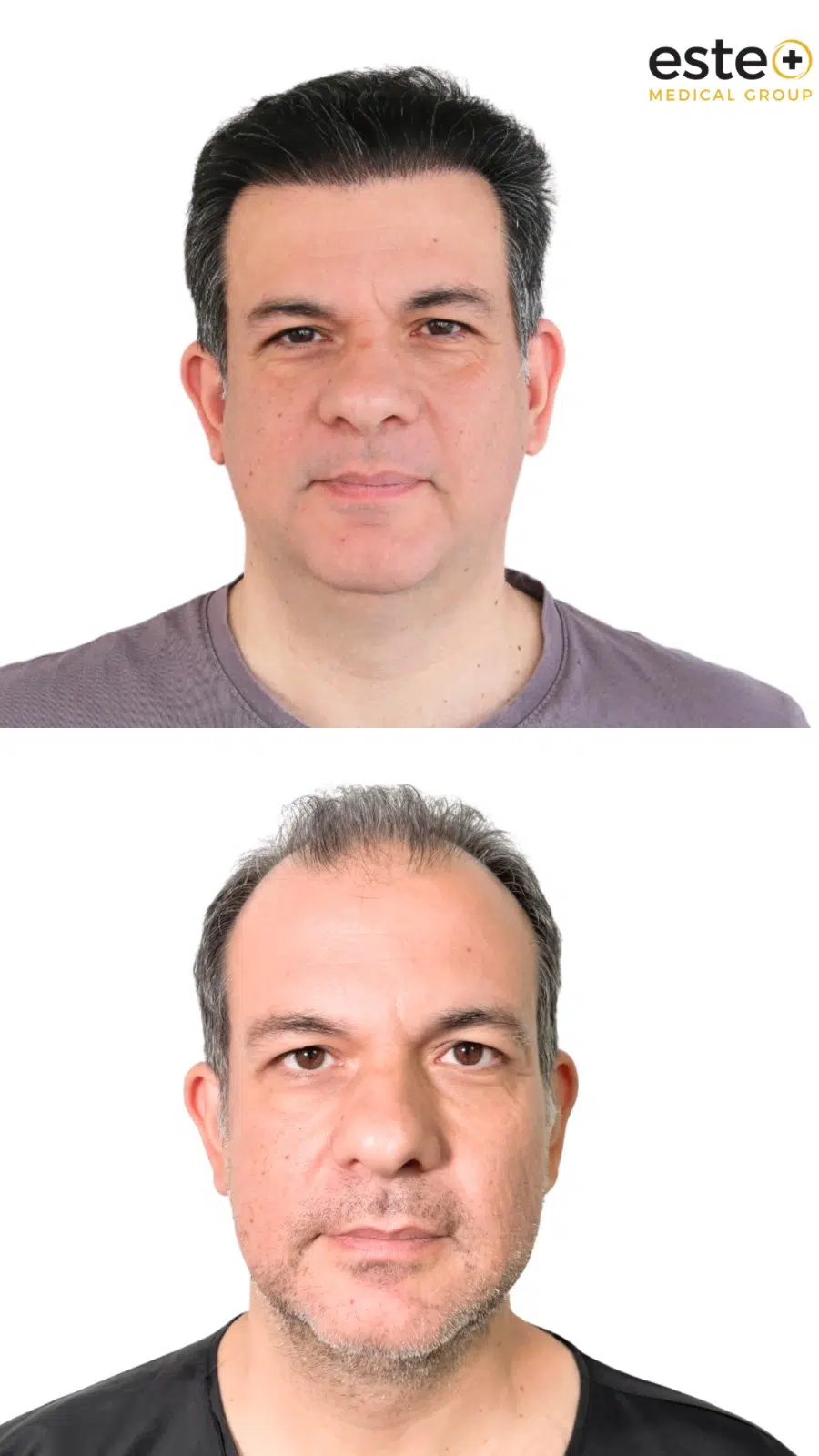 DHI hair transplant Dubai before and after patient results with improved hair density