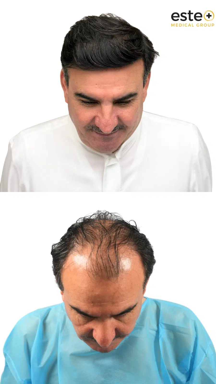 DHI hair transplant before and after images showing fuller hair coverage
