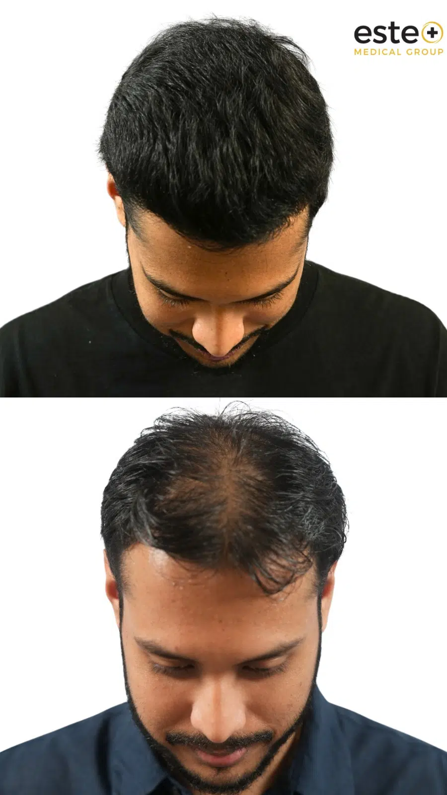 DHI hair transplant transformation showing fuller hair and improved hairline