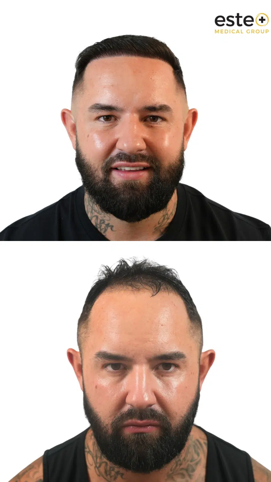 Hair restoration transformation at Este Medical Group Dubai clinic