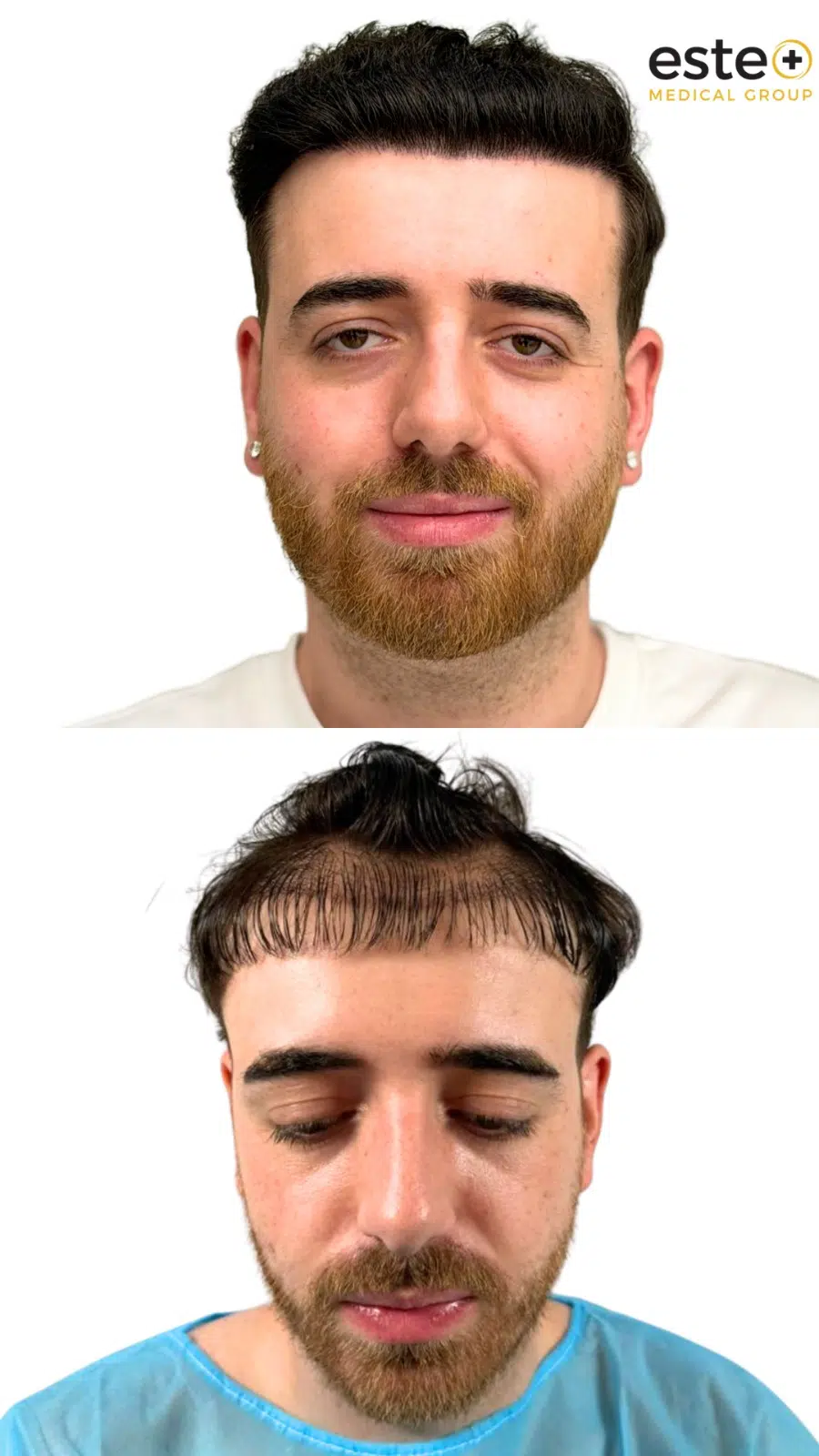 Hair transplant results Dubai showing natural looking hairline and fuller hair