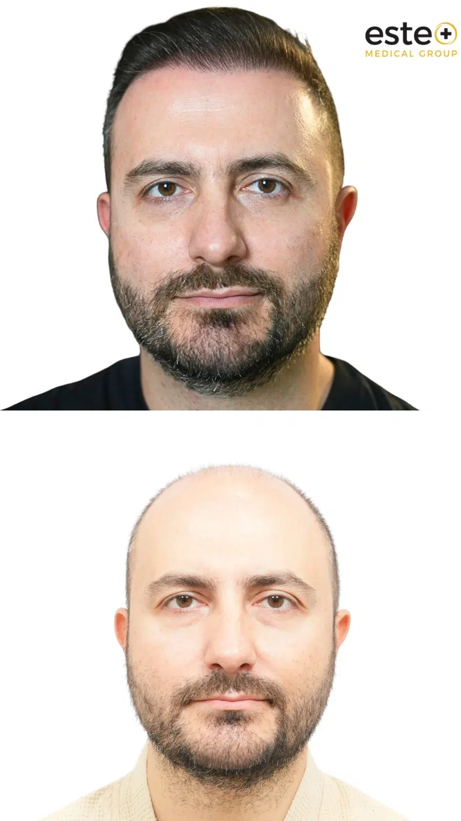Male pattern baldness before and after DHI hair transplant in Dubai