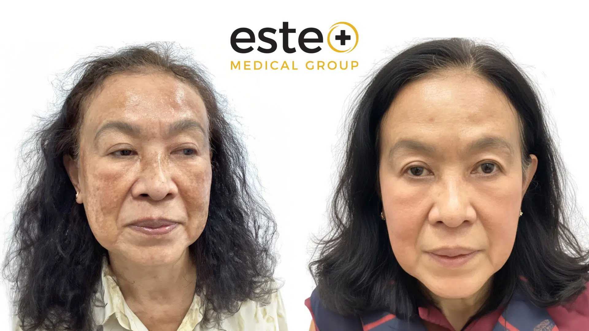 Pigmentation before and after