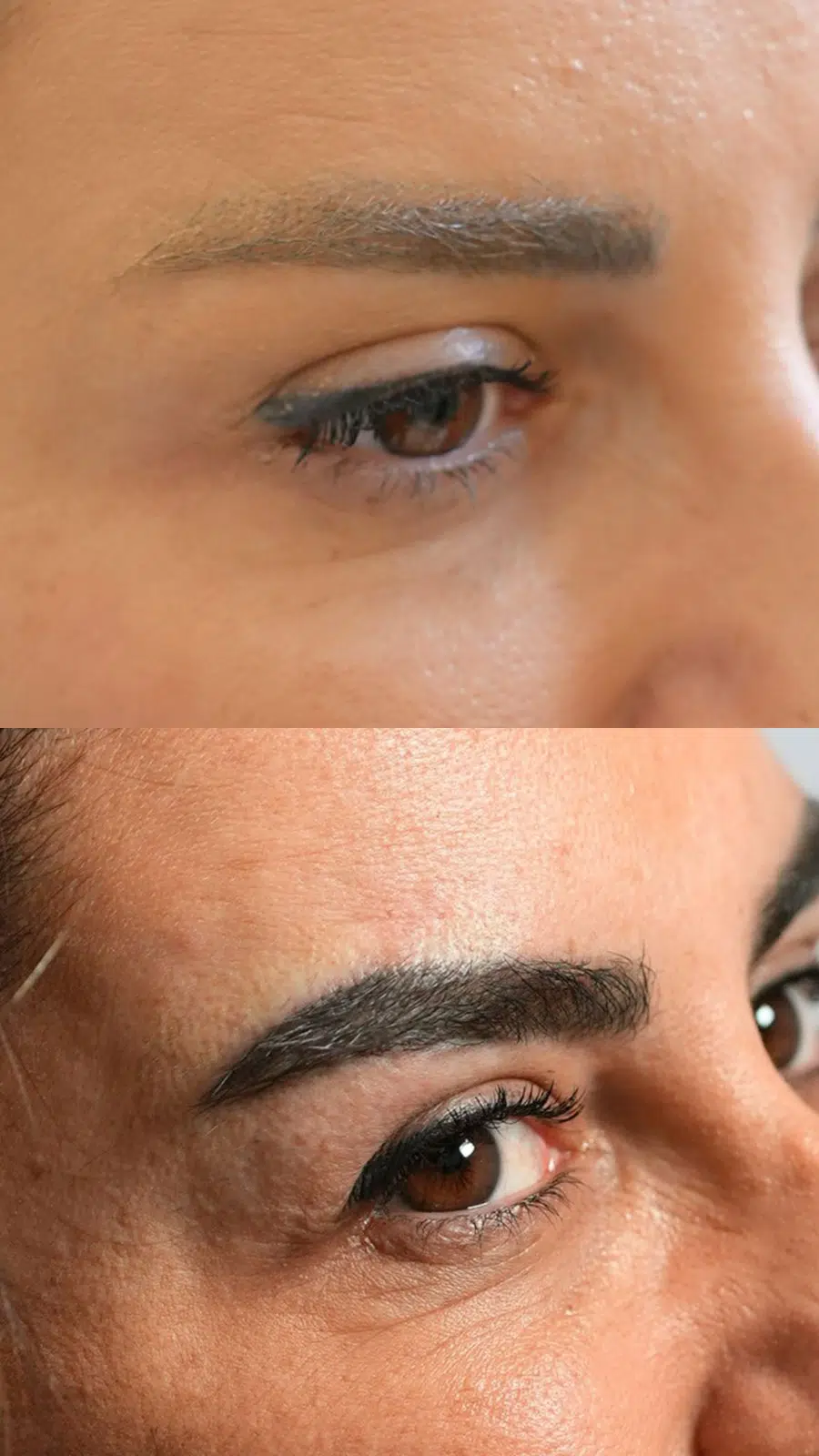 Eyebrow hair transplant before and after