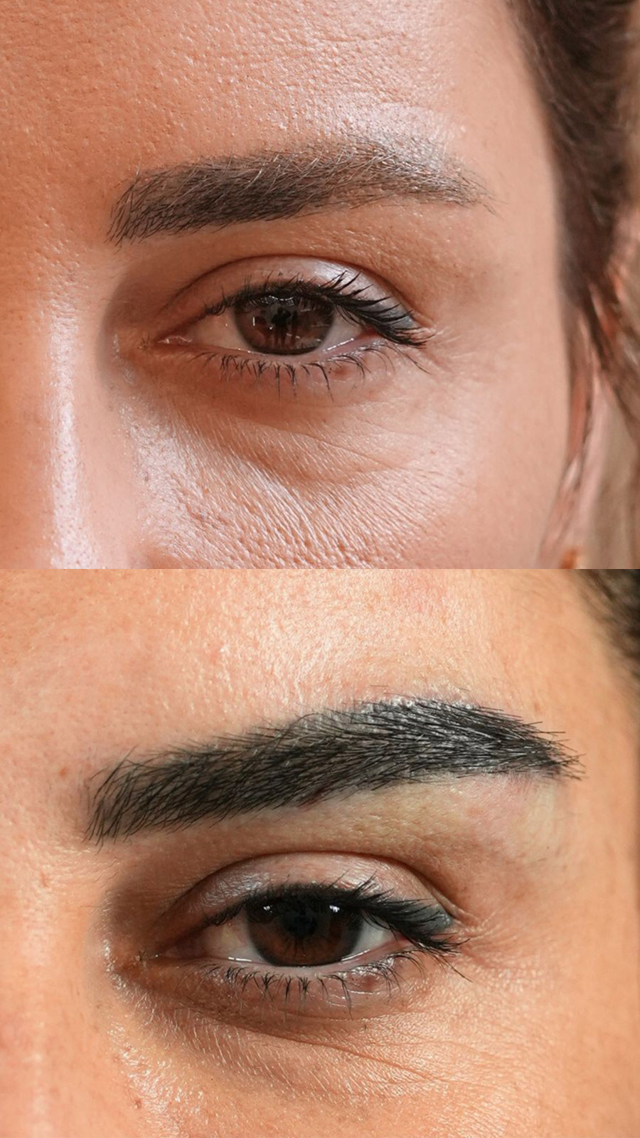 Eyebrow hair transplant treatment results