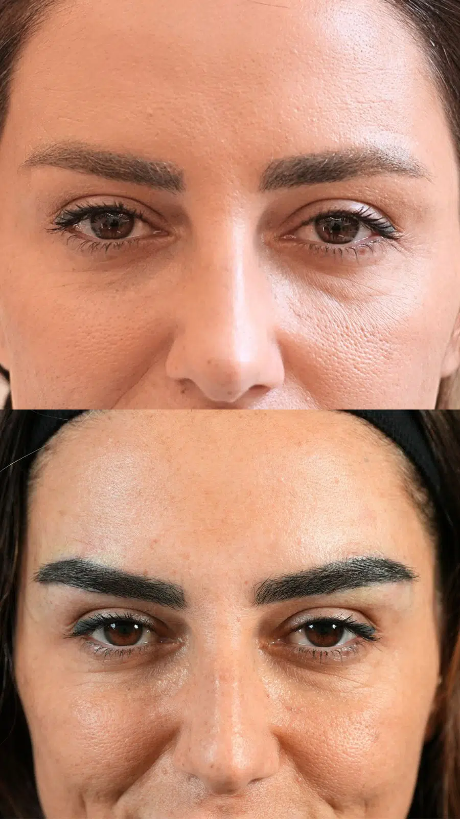 Eyebrow hair transplant treatment results