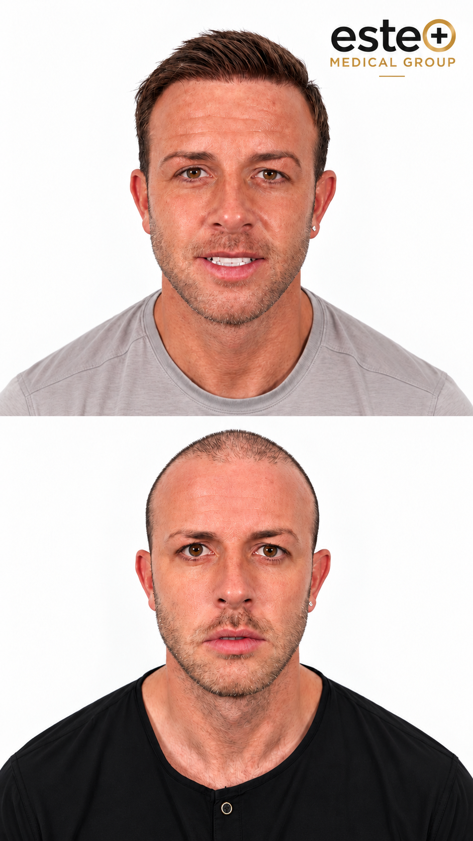 Hair Transplant before and after result