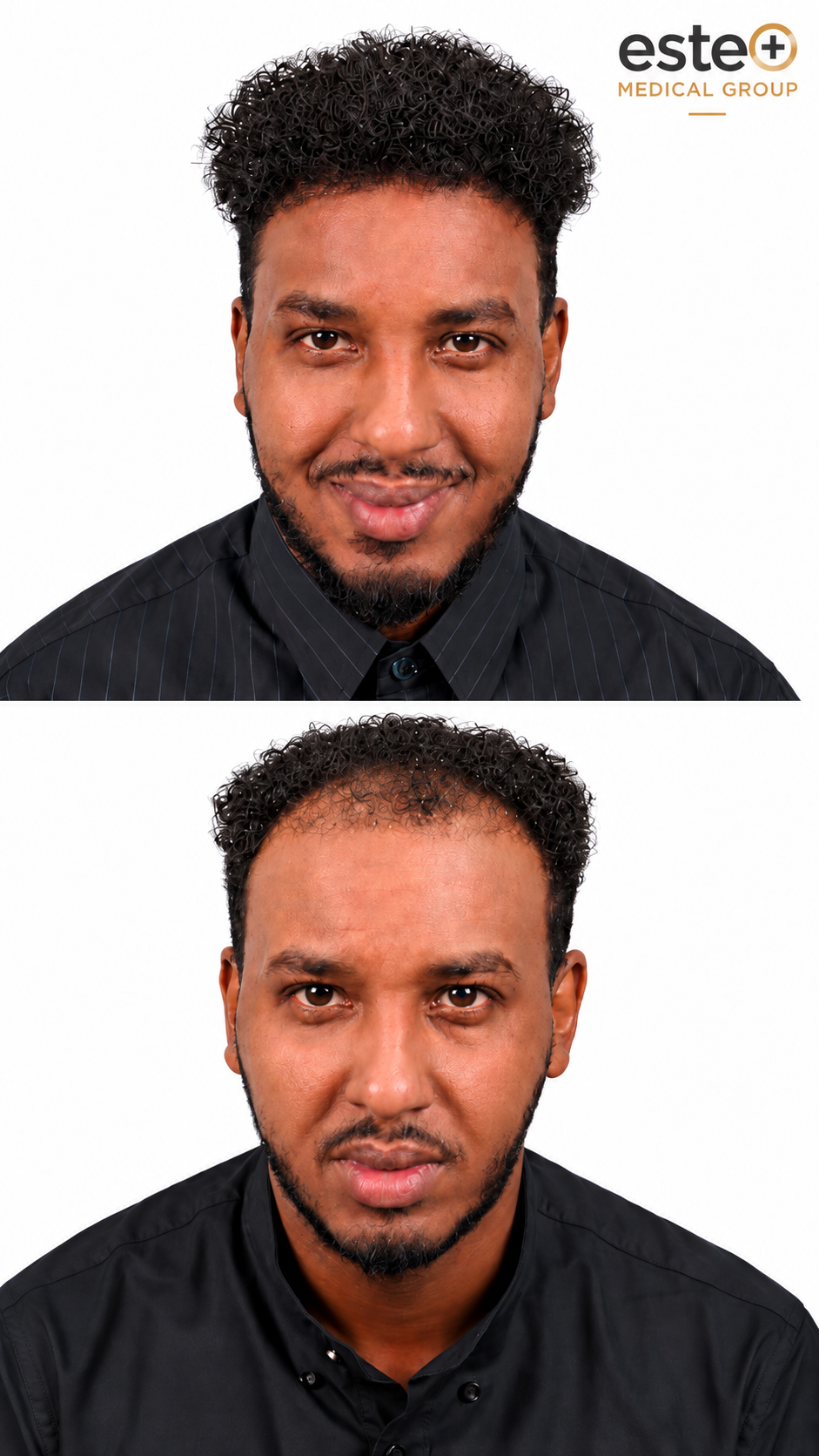 Hair Transplant results